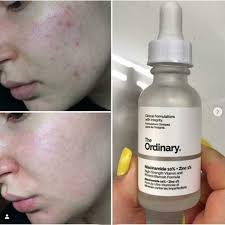 The Ordinary Niacinamide 10% + Zinc 1 % |oil Control, Pore Minimizing & Blemish Solution Serum