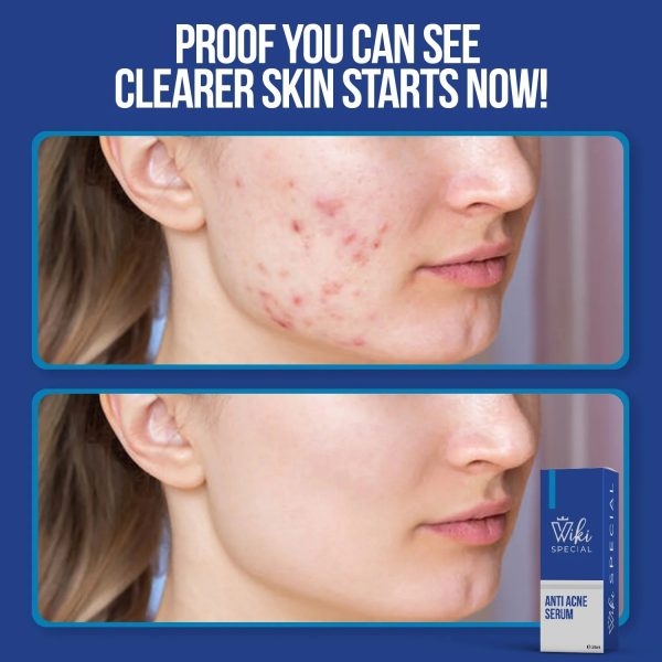 Wiki Special Anti Acne Serum – 30ml