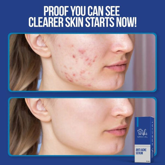 Wiki Special Anti Acne Serum – 30ml